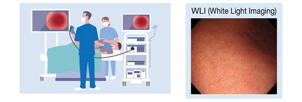 Figure 1 Endoscope, Figure 2 WLI (White Light Imaging) Observation